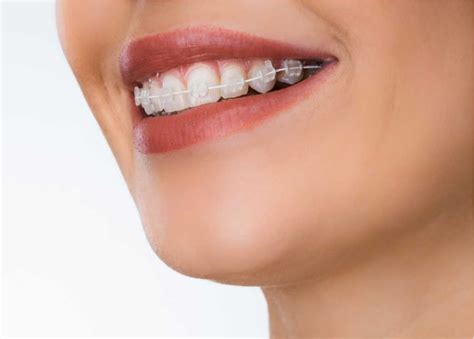 precio brackets metalicos|brackets linguales precio.